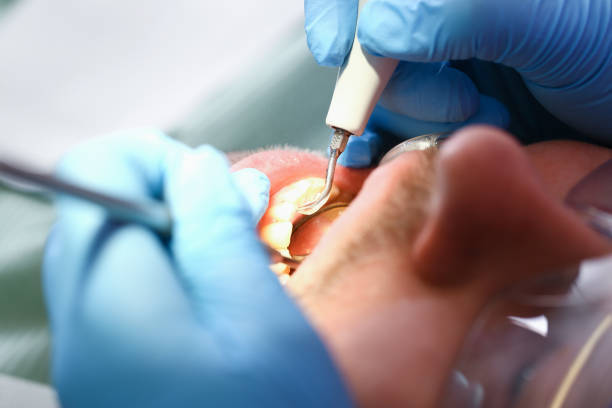 Best Dental Abscess Treatment in Grimes, IA